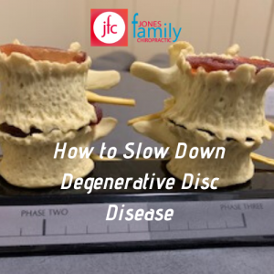 Read more about the article Degenerative discs: How to slow down the process – Dr. Jason Jones Elizabeth City NC Chiropractor